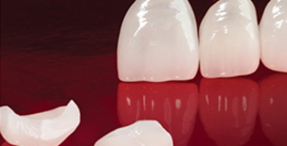 Dental Veneers in San Pablo, CA