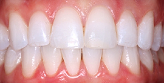 Teeth Whitening in Richmond, CA